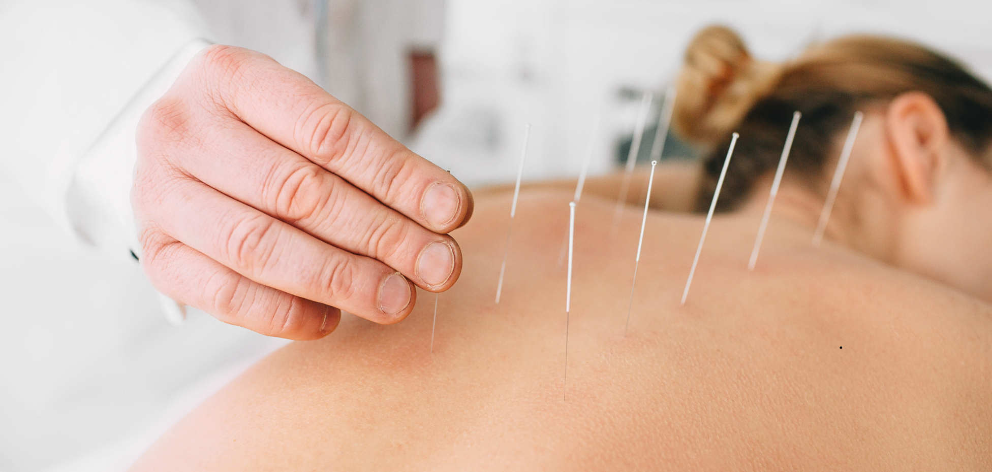 Close-up of acupuncture needles on a person's back