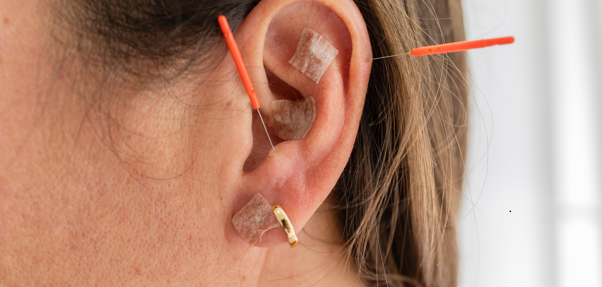 Close-up of a human ear showing acupuncture seeds